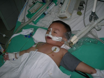 Sự sống nguy kịch của bé 21 tháng tuổi bị nhiễm trùng huyết - 1 Sự sống nguy kịch của bé 21 tháng tuổi bị nhiễm trùng huyết - 1