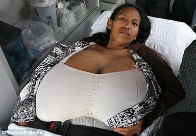 Nằm liệt giường vì bộ ngực khổng lồ - 1