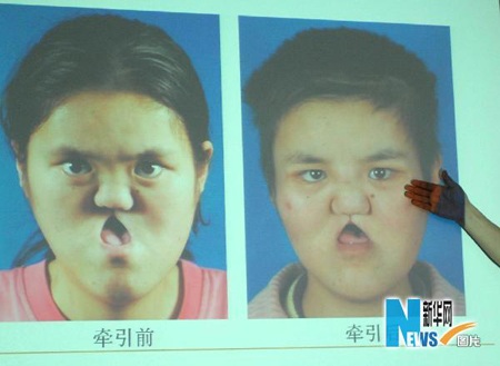 Phẫu thuật cấy ghép cho bệnh nhân “mặt lõm” - 2 Phẫu thuật cấy ghép cho bệnh nhân “mặt lõm” - 2