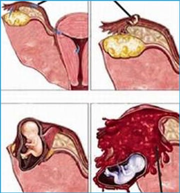 Chửa ngoài tử cung - nguy hiểm vì dễ bỏ qua triệu chứng - 1 Chửa ngoài tử cung - nguy hiểm vì dễ bỏ qua triệu chứng - 1