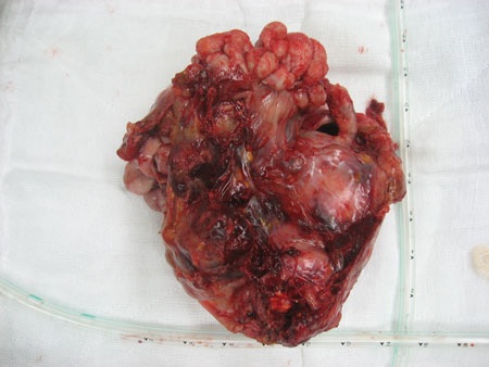 Cứu sống bệnh nhân bị khối u 2,2 kg chèn ép tim - 1