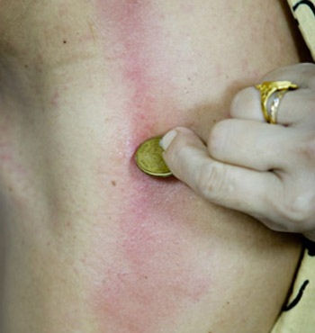 Cạo gió đúng cách! - 1 Cạo gió đúng cách! - 1