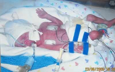 Chuyển dạ 3 tuần, sinh non ở tháng thứ 5 - 1 Chuyển dạ 3 tuần, sinh non ở tháng thứ 5 - 1