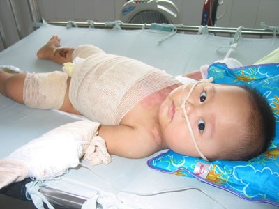 Bé 11 tháng tuổi bỏng nước sôi sắp được xuất viện - 1 Bé 11 tháng tuổi bỏng nước sôi sắp được xuất viện - 1