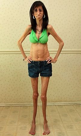 Ảnh cô gái siêu gầy của nước Mỹ - 4 Ảnh cô gái siêu gầy của nước Mỹ - 4