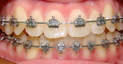 Những điều cần biết về chỉnh nha - 3 Những điều cần biết về chỉnh nha - 3