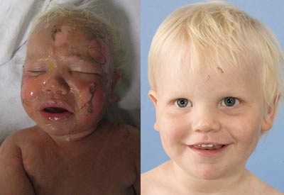 Bé 13 tháng tuổi bị bỏng cả mặt vì nước trà nóng - 1