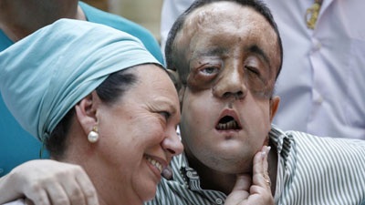 Pháp tuyên bố thực hiện ca ghép toàn mặt thực sự đầu tiên - 2