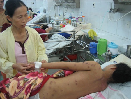 Cứu sống một học sinh bị ong vò vẽ đốt hơn 100 mũi - 1 Cứu sống một học sinh bị ong vò vẽ đốt hơn 100 mũi - 1