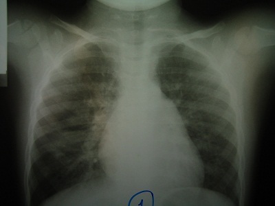 Lao sơ nhiễm trẻ em - Vấn đề đang bị bỏ quên! - 1