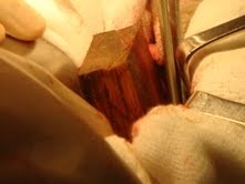 Cứu sống bệnh nhân bị cọc gỗ 1,2m đâm xuyên bụng - 1 Cứu sống bệnh nhân bị cọc gỗ 1,2m đâm xuyên bụng - 1