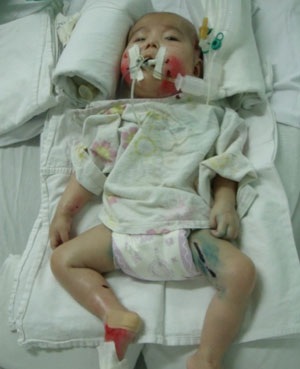 Diễn tiến bệnh của bé Nhân Ái đang xấu đi - 1
