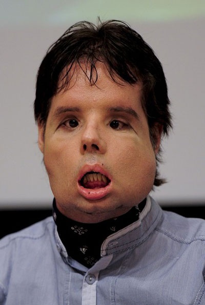 Người đầu tiên được ghép toàn mặt “khoe” diện mạo mới - 4