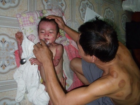 Tiếp sức cho cháu bé “ngày nào cũng bị lột da” - 3