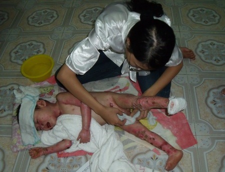 Tiếp sức cho cháu bé “ngày nào cũng bị lột da” - 4