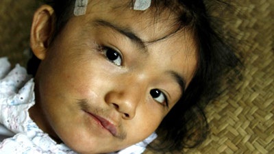 Cô bé mắc bệnh rậm lông hiếm gặp - 1