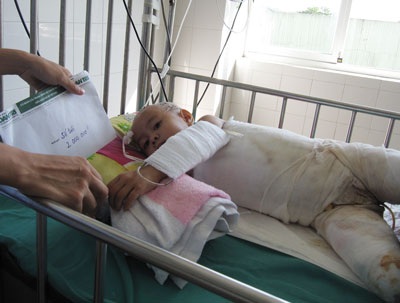 Quỹ Nhân ái đến với bé gái bị bỏng nặng toàn thân - 1 Quỹ Nhân ái đến với bé gái bị bỏng nặng toàn thân - 1
