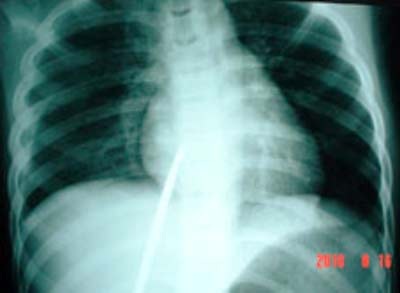 Sơ ý, một trẻ bị đâm thủng tim phổi - 1