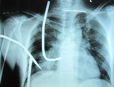 Cứu sống bệnh nhân bị đinh ba đâm xuyên ngực - 2