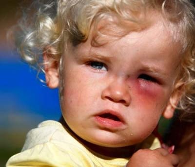 Nguy cơ mù mắt do tiếp xúc với chó nhiễm giun - 1