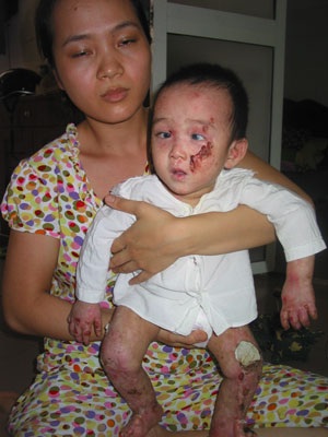 Thương vô cùng bé 13 tháng tuổi bị bệnh “lột da ếch” - 3 Thương vô cùng bé 13 tháng tuổi bị bệnh “lột da ếch” - 3