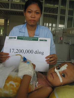 Bé gái bị bỏng toàn thân đã qua cơn nguy kịch - 1 Bé gái bị bỏng toàn thân đã qua cơn nguy kịch - 1