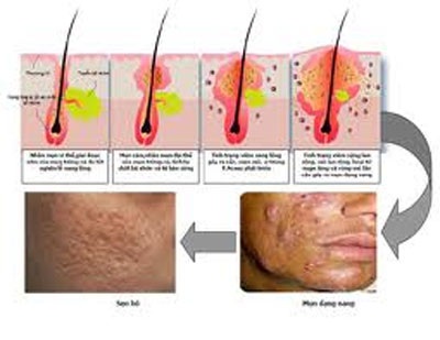 7 thắc mắc thường gặp về mụn trứng cá - 1 7 thắc mắc thường gặp về mụn trứng cá - 1
