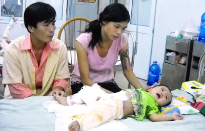 Bỏng nặng, bé 6 tháng tuổi nhiều lần mấp mẻ cửa tử - 1 Bỏng nặng, bé 6 tháng tuổi nhiều lần mấp mẻ cửa tử - 1