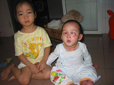 Hơn 30 triệu đồng đến với cậu bé bị “lột da ếch” - 1 Hơn 30 triệu đồng đến với cậu bé bị “lột da ếch” - 1