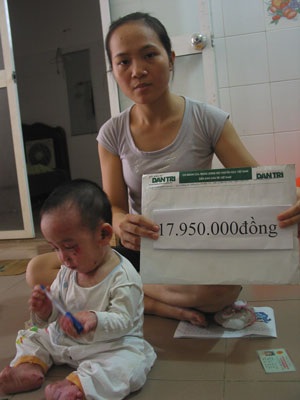 Hơn 30 triệu đồng đến với cậu bé bị “lột da ếch” - 2 Hơn 30 triệu đồng đến với cậu bé bị “lột da ếch” - 2