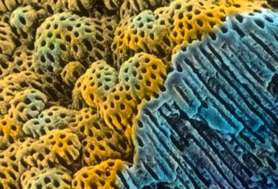 Răng ê buốt do đâu? - 4