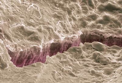 Răng ê buốt do đâu? - 5