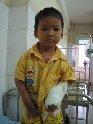Phẫu thuật tay cho bé Nguyên bỏng vôi toàn thân - 1