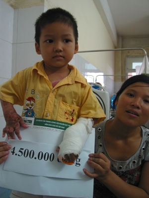 Phẫu thuật tay cho bé Nguyên bỏng vôi toàn thân - 2