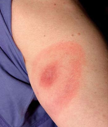 Bí ẩn bọ cắn chết người ở Trung Quốc - 1