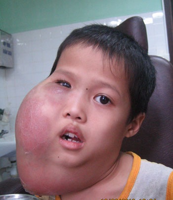 Bóc tách thành công khối u nặng 2kg “treo” trên mặt bệnh nhi - 1