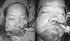 Ghép thành công một phần mặt đứt lìa - 1