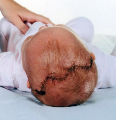 Sự hồi phục kỳ diệu của bé gái bị bổ đôi hộp sọ - 3