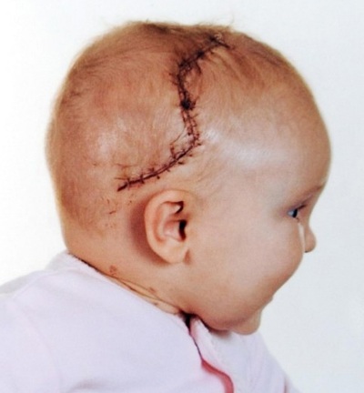 Sự hồi phục kỳ diệu của bé gái bị bổ đôi hộp sọ - 4