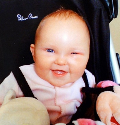 Sự hồi phục kỳ diệu của bé gái bị bổ đôi hộp sọ - 2