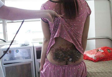 Bị cha mẹ đánh dã man vì… không chịu lấy chồng - 1 Bị cha mẹ đánh dã man vì… không chịu lấy chồng - 1