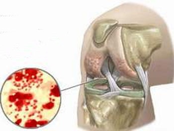 Sưng khớp vì quan hệ tình dục bừa bãi - 1 Sưng khớp vì quan hệ tình dục bừa bãi - 1
