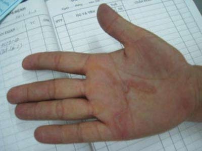 Hải Phòng: Xuất hiện bệnh giun bò dưới da - 2 Hải Phòng: Xuất hiện bệnh giun bò dưới da - 2