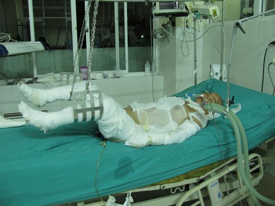 Bỏng 85% cơ thể do ngã vào nồi cám lợn đang sôi - 1 Bỏng 85% cơ thể do ngã vào nồi cám lợn đang sôi - 1