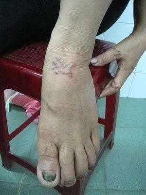 Giun bò dưới da là loại gì? - 1