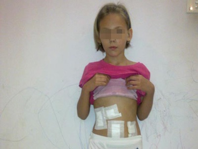 Búi tóc nặng 0,5kg trong dạ dày một bé gái - 2