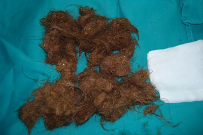 Búi tóc nặng 0,5kg trong dạ dày một bé gái - 1