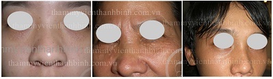 Mụn thịt quanh mắt và những biến chứng nguy hiểm - 2 Mụn thịt quanh mắt và những biến chứng nguy hiểm - 2