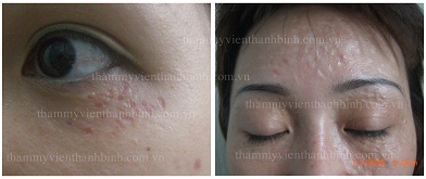Mụn thịt quanh mắt và những biến chứng nguy hiểm - 3 Mụn thịt quanh mắt và những biến chứng nguy hiểm - 3