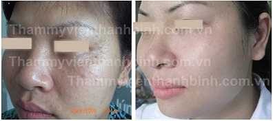 Mụn thịt quanh mắt và những biến chứng nguy hiểm - 4 Mụn thịt quanh mắt và những biến chứng nguy hiểm - 4